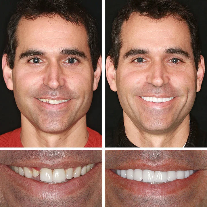 SmileLock – Premium Full Denture Solution – image 7