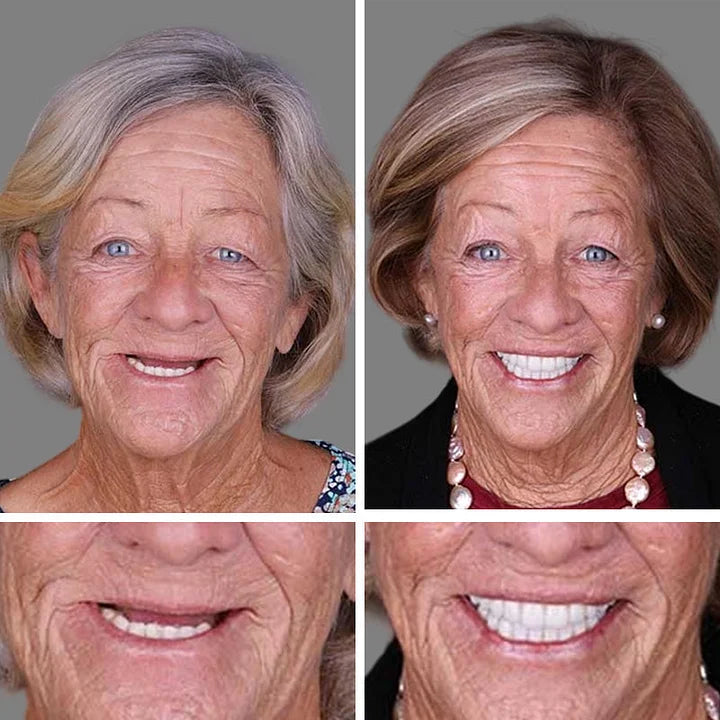 SmileLock – Premium Full Denture Solution – image 8