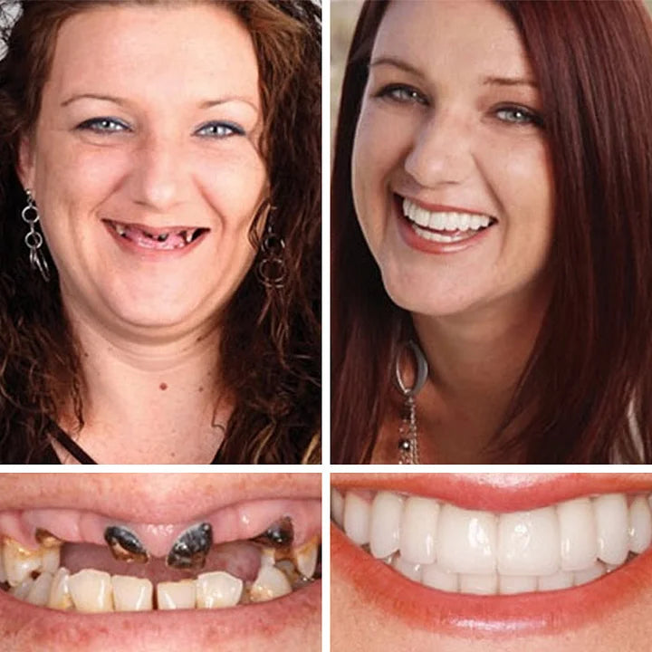 SmileLock – Premium Full Denture Solution – image 9