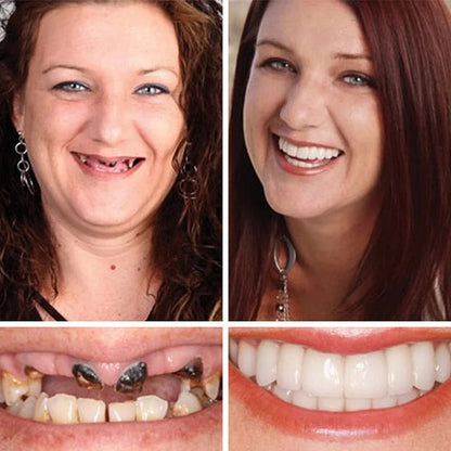 SmileLock – Premium Full Denture Solution – image 9