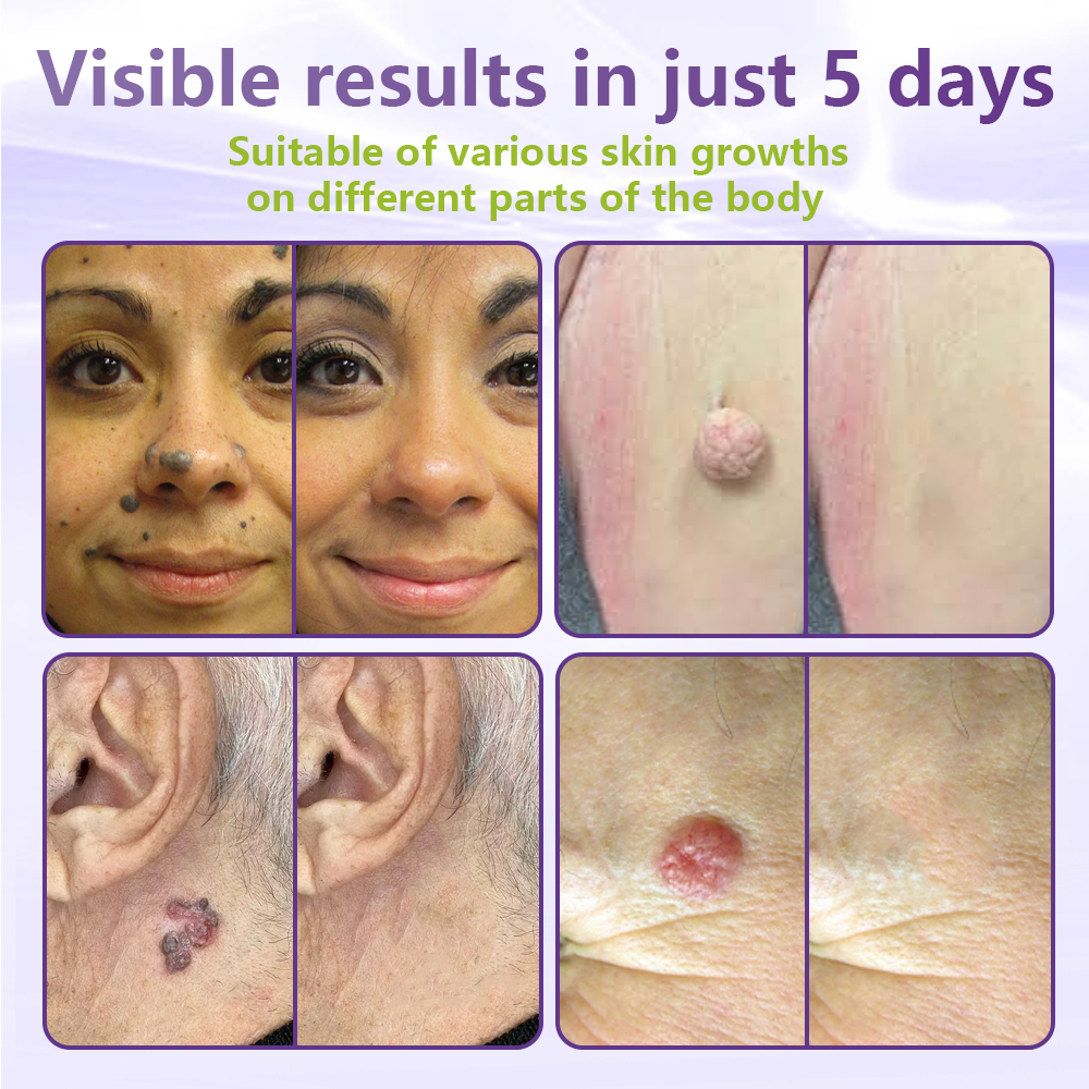 ClearDerma – Microneedle Skin Tag Removal Patch – image 4