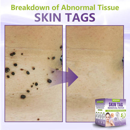 ClearDerma – Microneedle Skin Tag Removal Patch – image 5