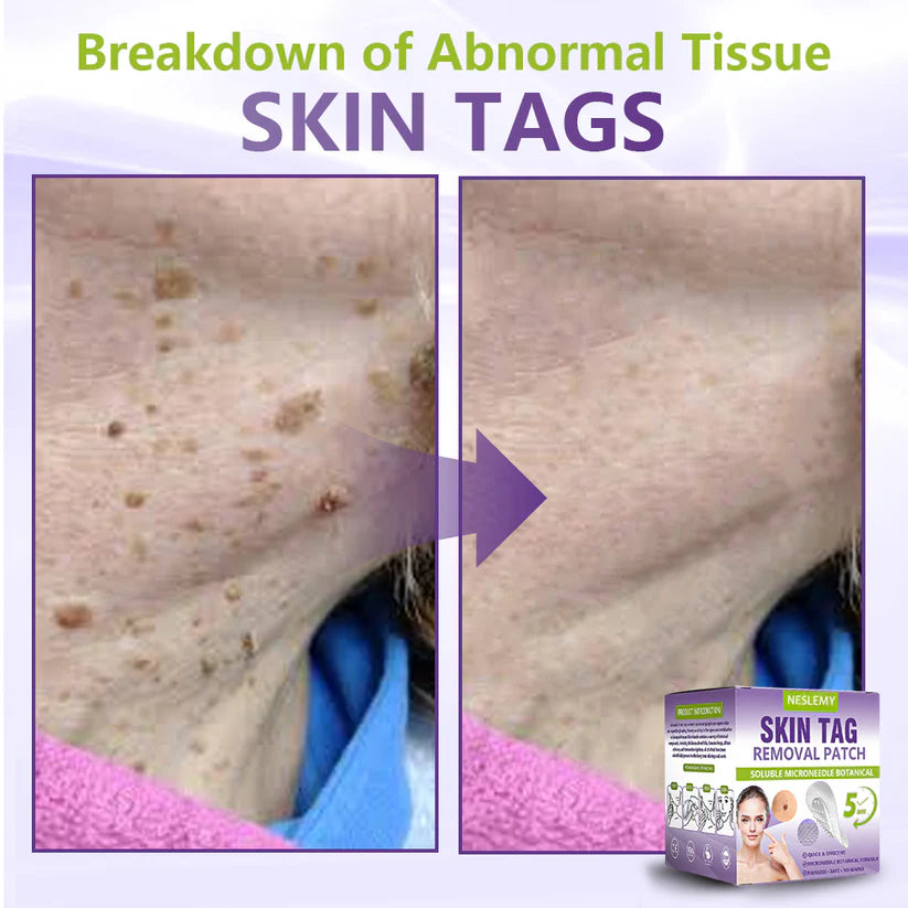 ClearDerma – Microneedle Skin Tag Removal Patch – image 6