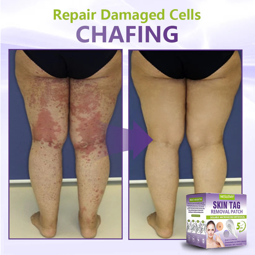 ClearDerma – Microneedle Skin Tag Removal Patch – image 7