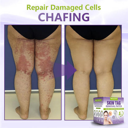 ClearDerma – Microneedle Skin Tag Removal Patch – image 7
