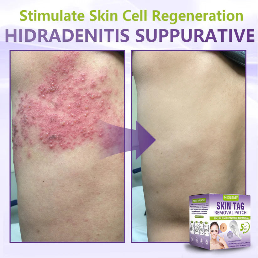 ClearDerma – Microneedle Skin Tag Removal Patch – image 9