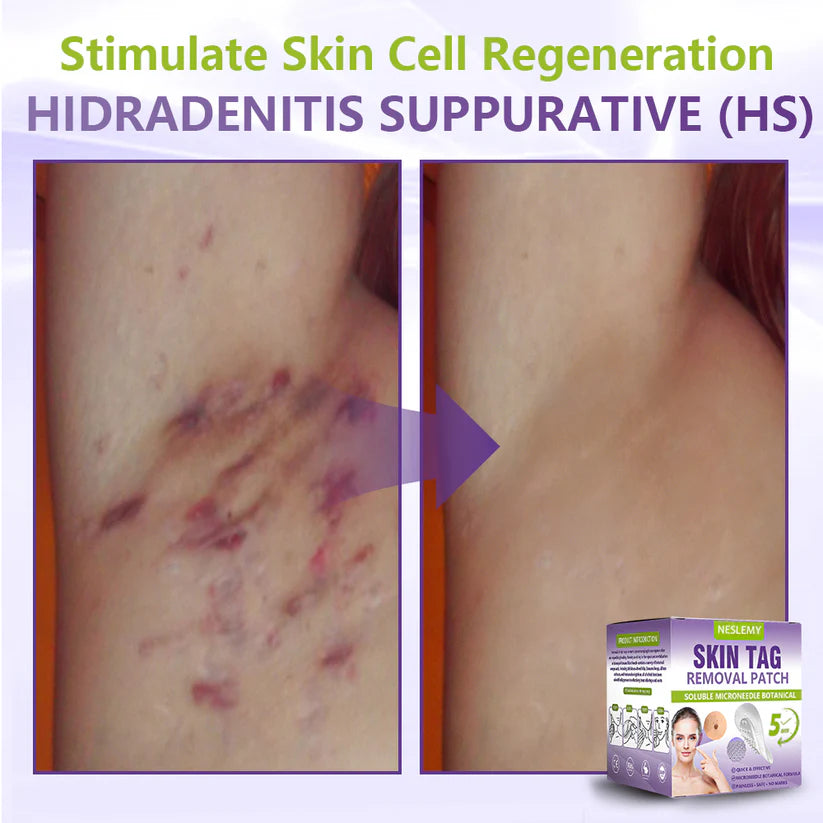 ClearDerma – Microneedle Skin Tag Removal Patch – image 10