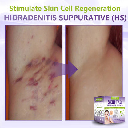 ClearDerma – Microneedle Skin Tag Removal Patch – image 10