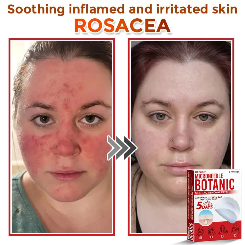 Natrvor –2-in-1 Microneedle Botanical Skin Renewal Patch – image 6