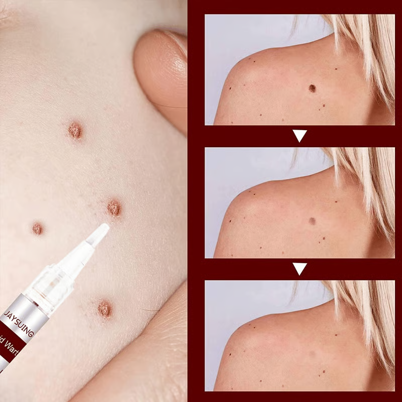 ClearGuard – Effective Wart Removal Pen – image 9