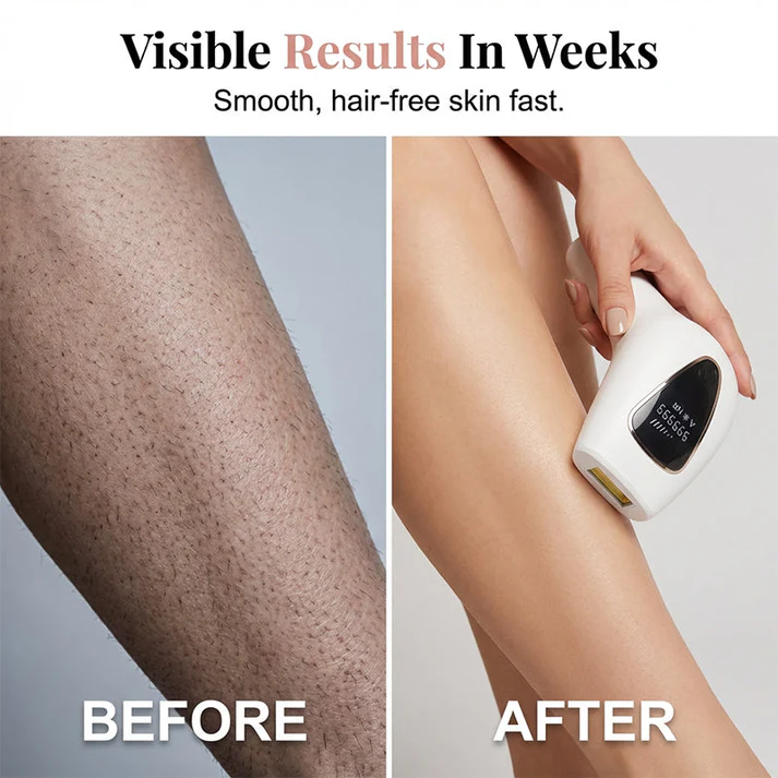LumiSmooth – Painless Hair Removal Device for Women – image 7