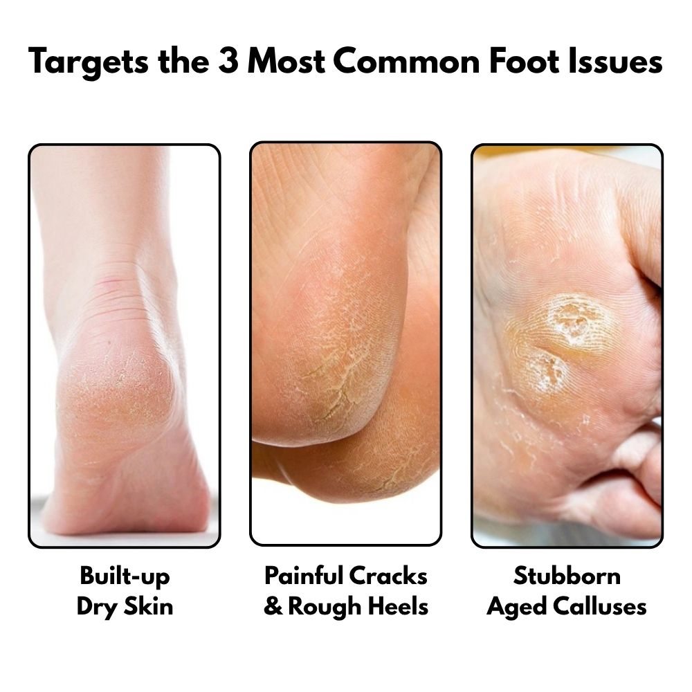 SilkySole Electric Callus Remover – image 4