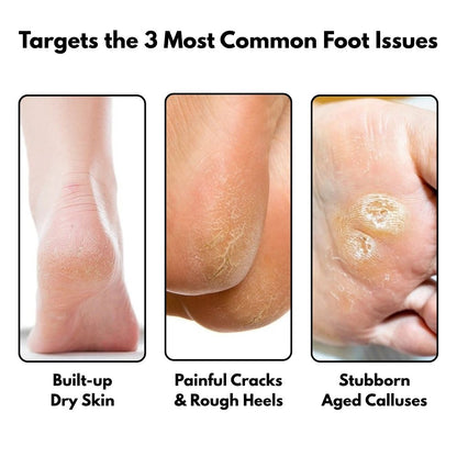 SilkySole Electric Callus Remover – image 4